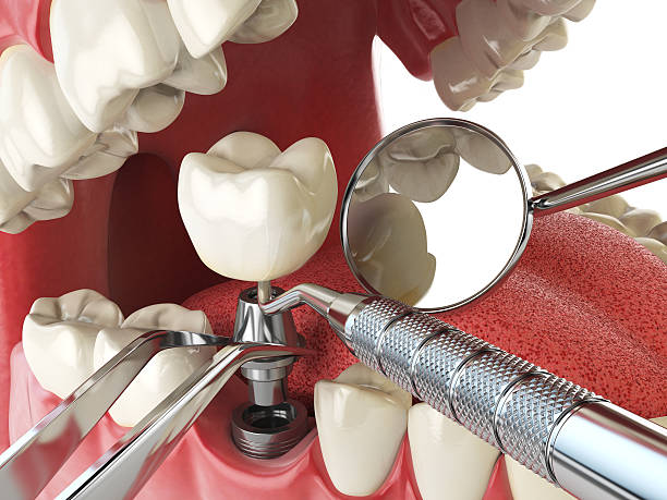 Best Tooth Infection Emergency Dentist  in Kensington Park, FL